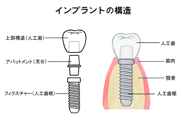 インプラントの構造