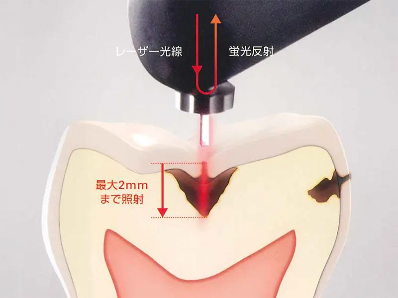 ダイアグノデントペン